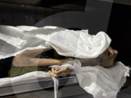 Gaza man dies of severe malnutrition