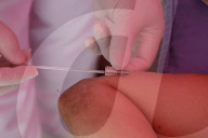 Tláhuac Municipality And Maternal And Child Hospital In Mexico City Conduct Free Subdermal Hormonal Implant Campaign