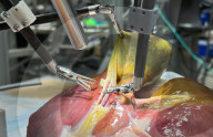 Robot surgeon performs gallbladder removal
