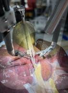 Robot surgeon performs gallbladder removal