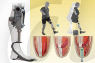 Bionic knee helps amputees walk faster and climb stars