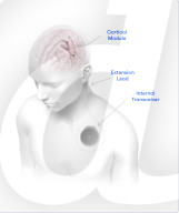 Brain implant to help the paralysed  speak