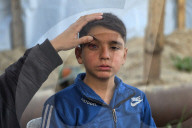Gaza boy struck in the eyes by shrapnel from Israeli missile