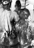 victim in nagasaki after atomic bomb strike in 1945